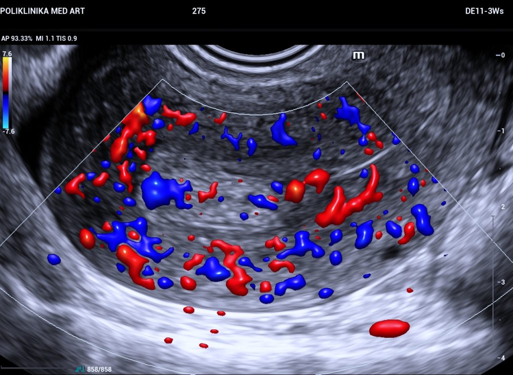 prikaz polipa na maternici